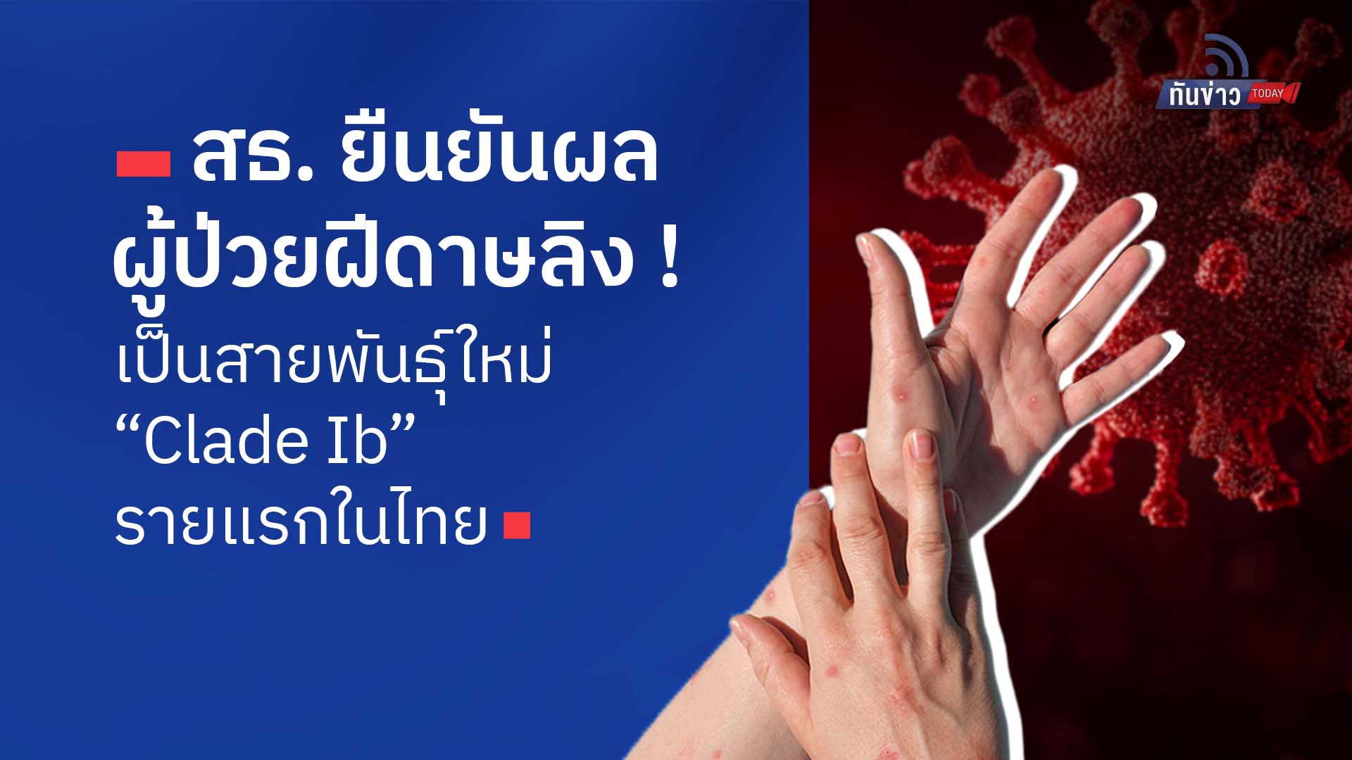 สธ. ยืนยันผลผู้ป่วยฝีดาษลิง เป็นสายพันธุ์ใหม่ “Clade Ib” รายแรกในไทย